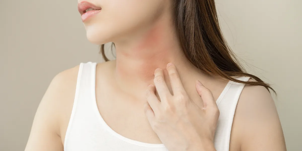 alergia al níquel