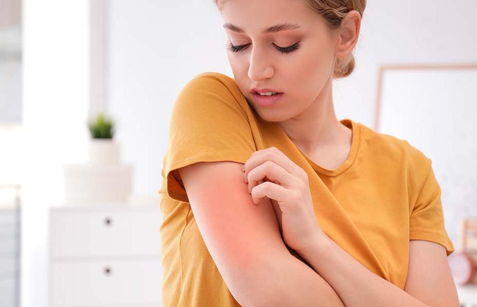 urticaria