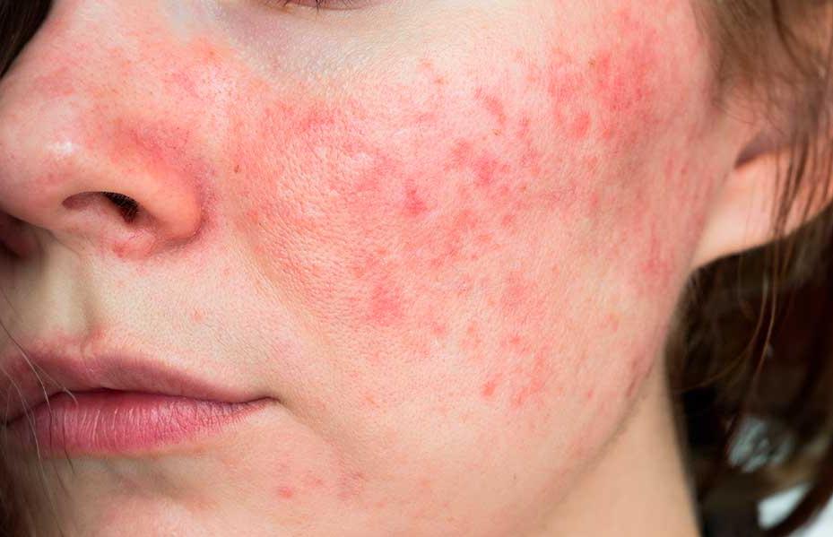 Demodex qué es y cómo afecta a tu piel