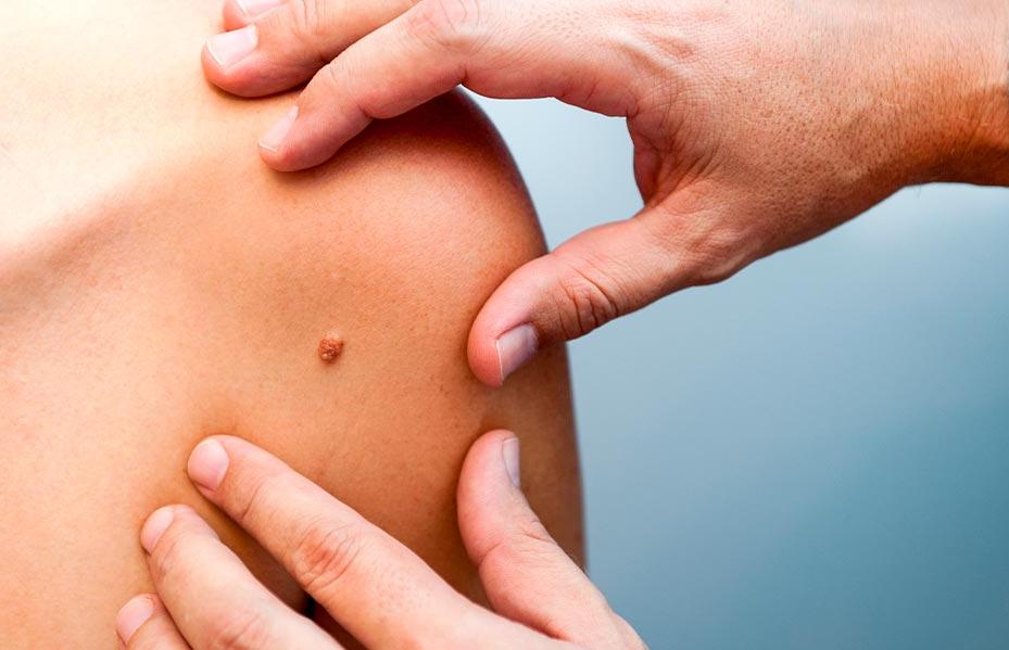 Fibroma en la piel: qué es y cómo eliminarlo