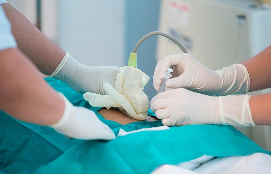 Prueba-de-la-amniocentesis