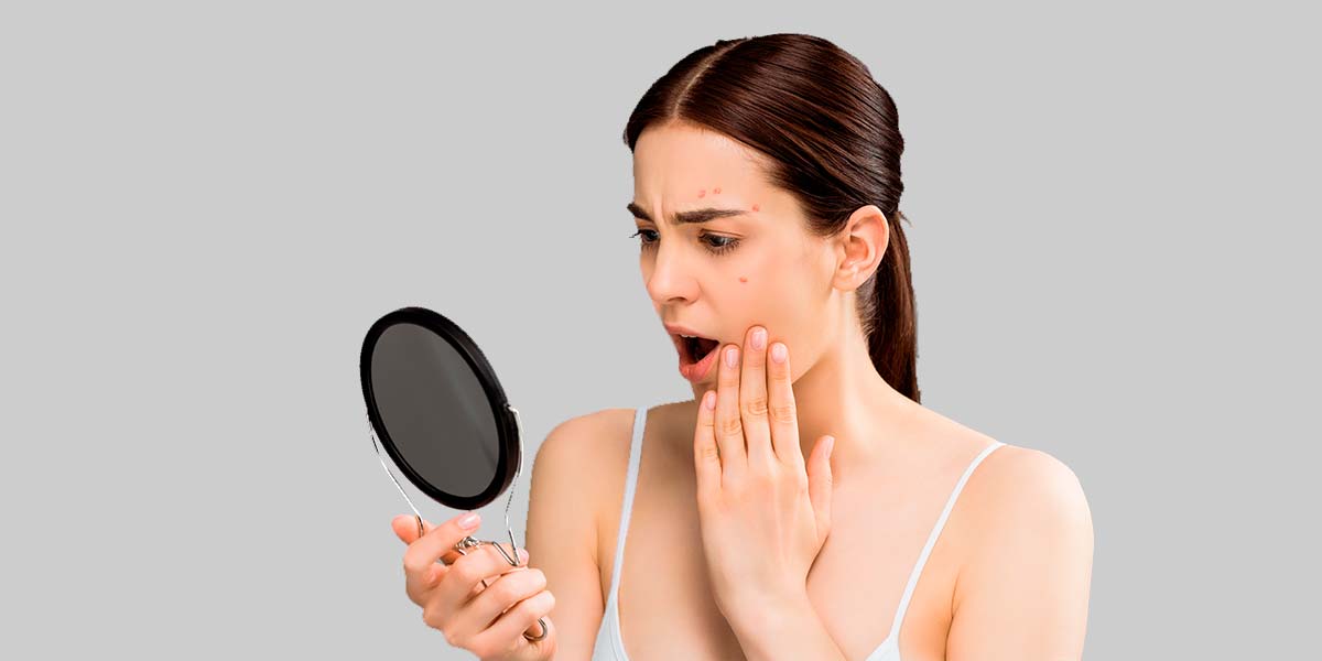 Principales tipos de acné: cuáles son y cómo tratarlos