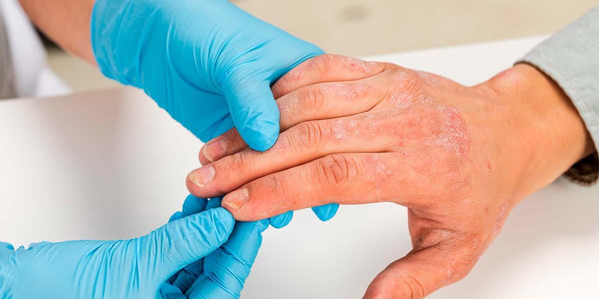 Dermatitis en las manos: qué es, causas y tratamiento