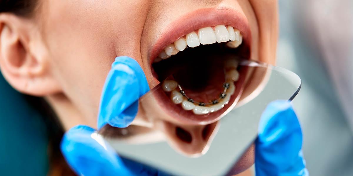 ¿Cómo puede ayudarte una ortodoncia lingual a favorecer tu salud bucodental?